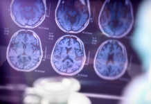 Un compuesto experimental mostró efectos contra el daño neuronal asociado al Alzheimer en ratones