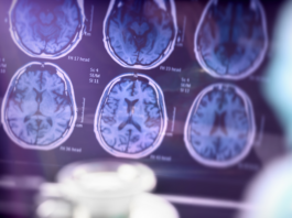 Con resultados prometedores, un compuesto experimental podría ralentizar el avance del Alzheimer