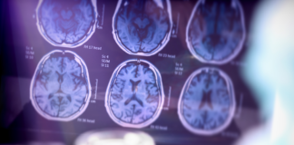 Con resultados prometedores, un compuesto experimental podría ralentizar el avance del Alzheimer
