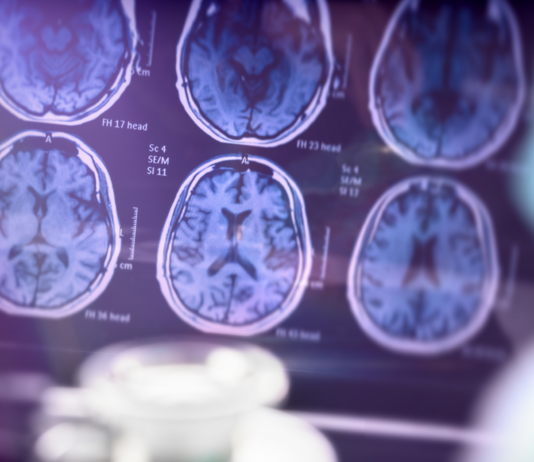 Con resultados prometedores, un compuesto experimental podría ralentizar el avance del Alzheimer